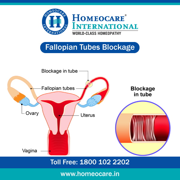 Homeopathic Remedies For Fallopian Tubes Blockage
