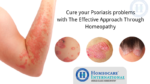 Cure your Psoriasis problems with The Effective Approach Through Homeopathy