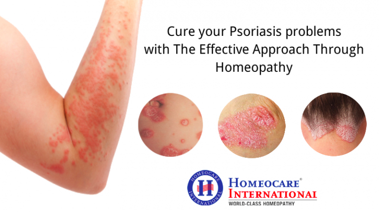 Cure Your Psoriasis Problems With The Effective Approach Through Homeopathy Homeocare