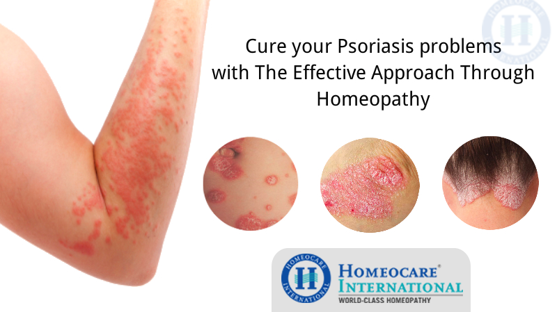 Homeopathy Treatment for Psoriasis