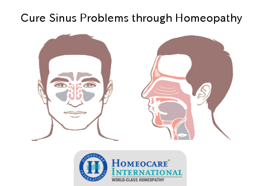 Sinus Treatment in Homeopathy