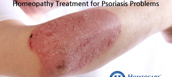 Homeopathy Treatment for Psoriasis