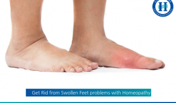 Get Rid from Swollen Feet problems with Homeopathy