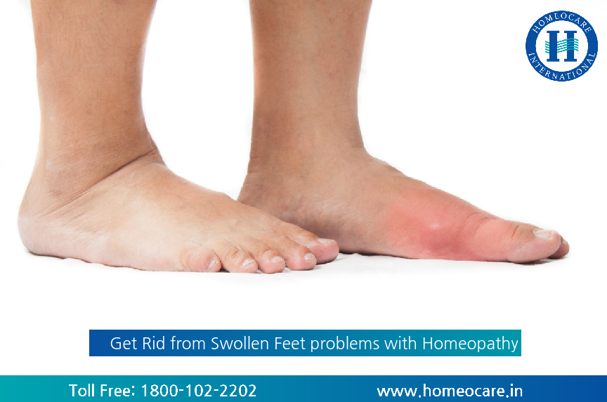 Get Rid from Swollen Feet problems with Homeopathy