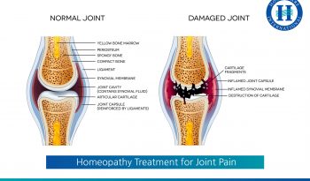 Homeopathy Treatment for Joint Pain
