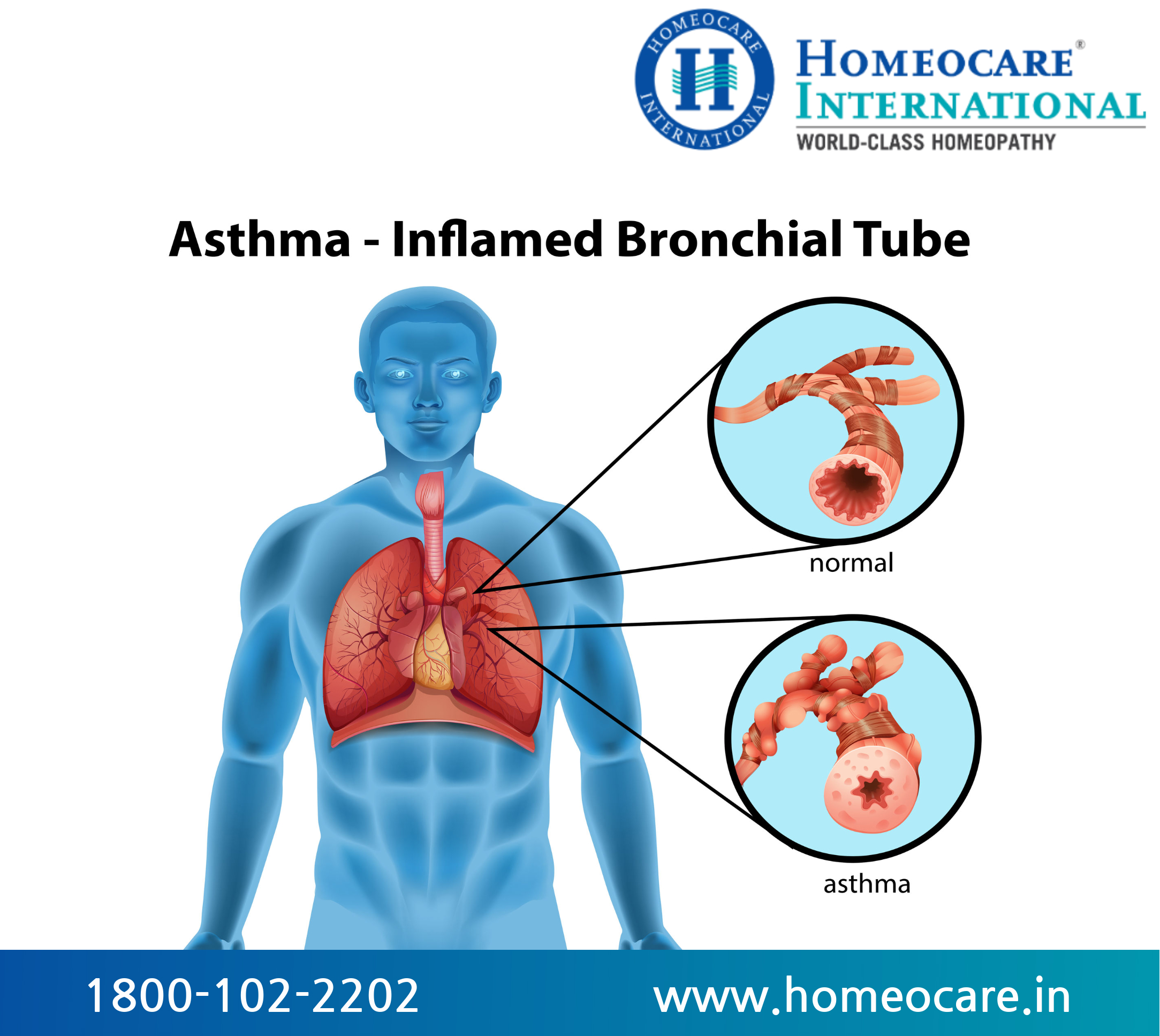 asthma inflamed bronchial tube