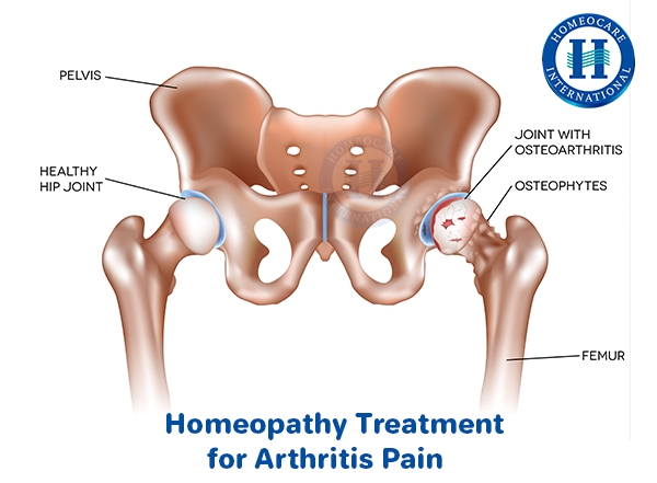 Homeopathy Treatment For Arthritis Pain