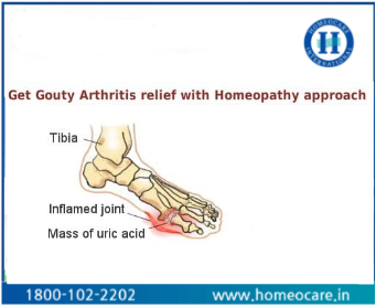 Homeopathy for Relief from Gouty Arthritis