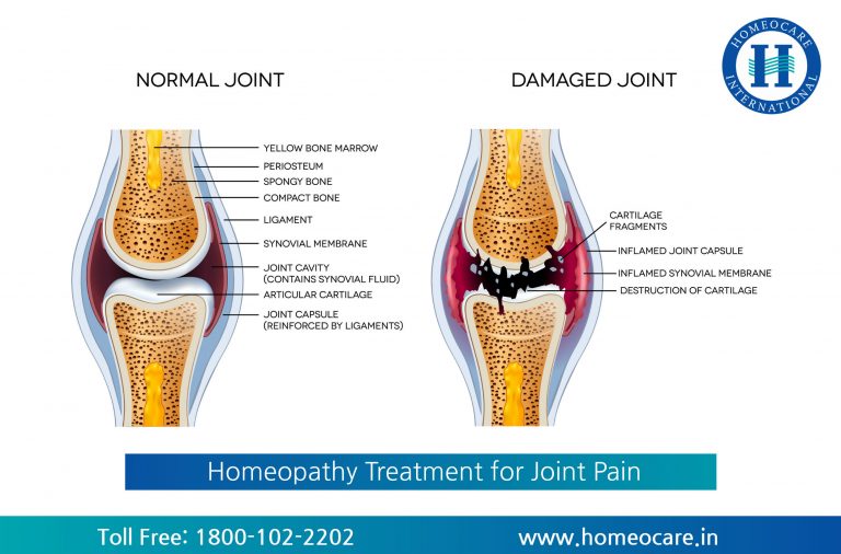homeopathy treatment for joint pain