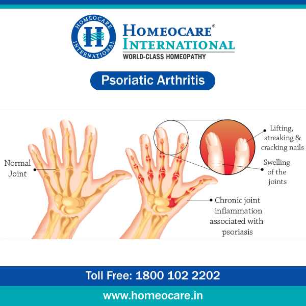 Best Treatment In Homeopathy For Psoriatic Arthritis Homeocare