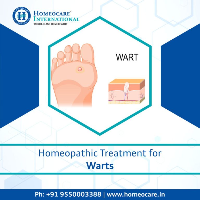 Homeopathy Treatment for Warts Homeocare International