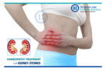 Kidney Stones Treatment in Homeopathy