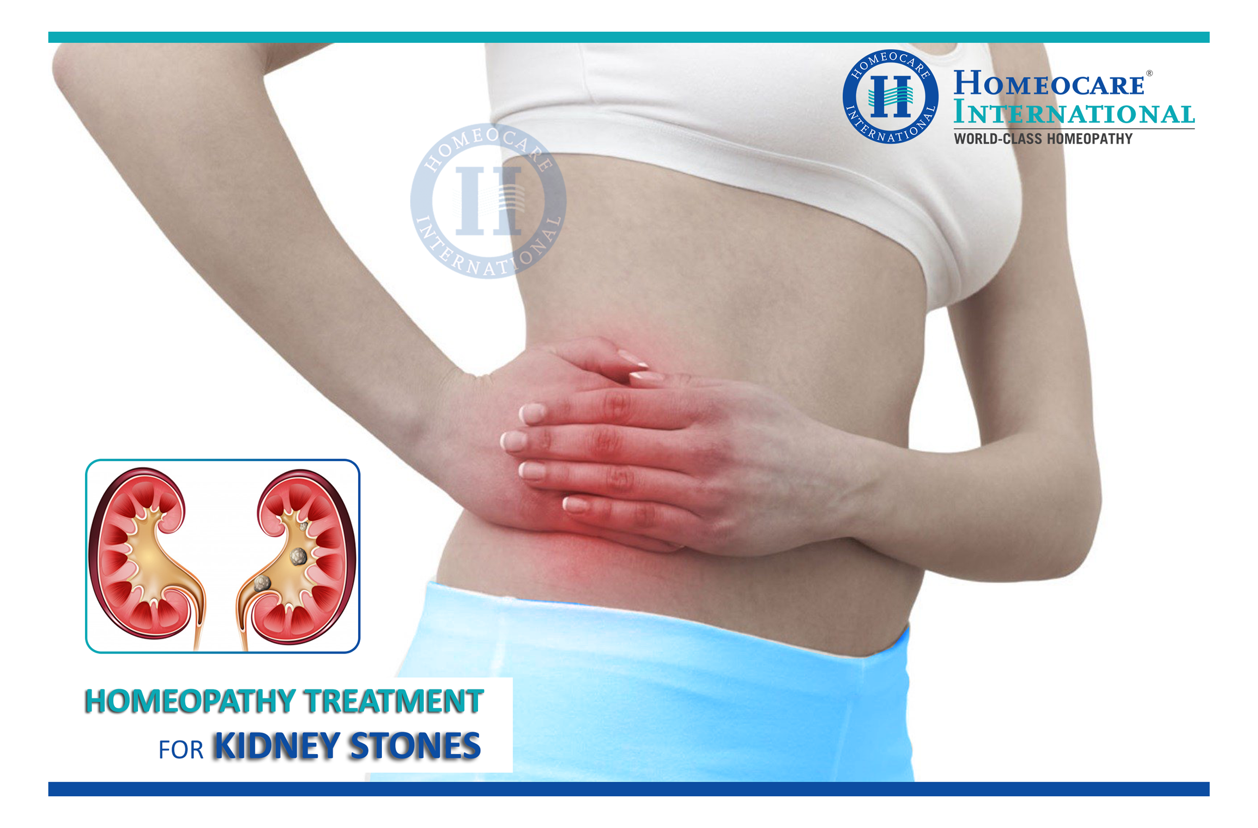 kidney stones