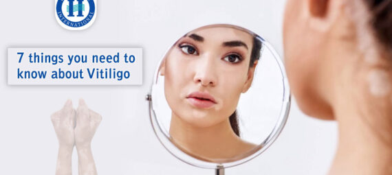 things you need to know about Vitiligo