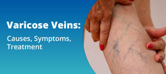 varicose veins