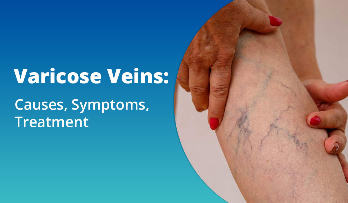 varicose veins
