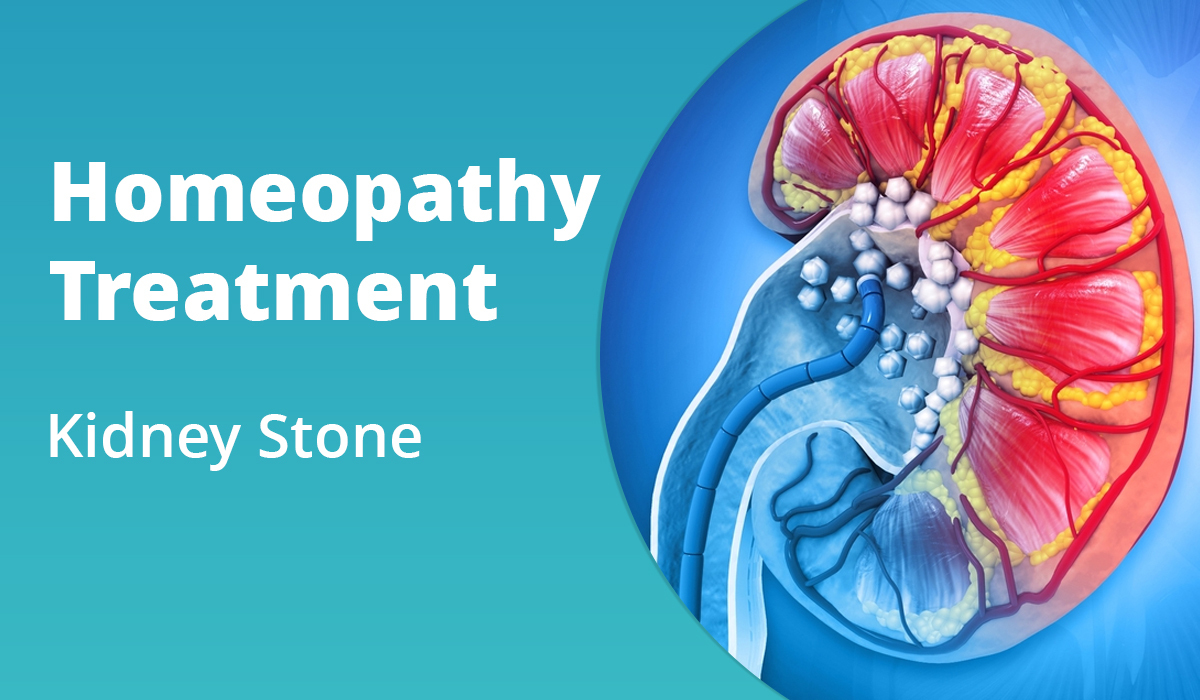 homeopathy treatment for kidney stone