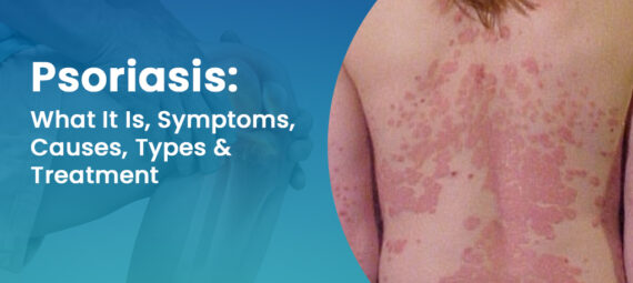 Psoriasis-symptoms,-causes,-types-&-treatment