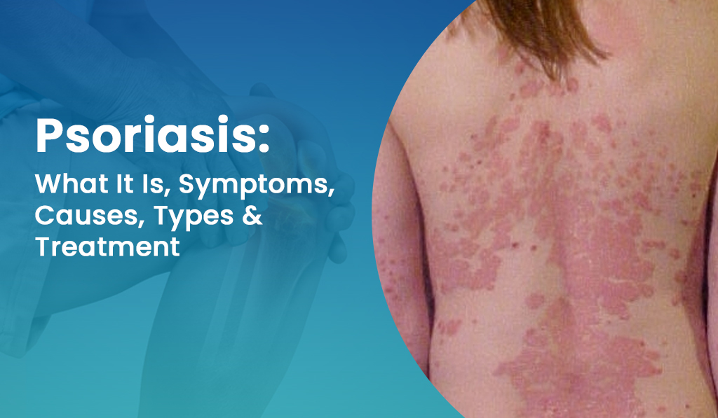 Psoriasis-symptoms,-causes,-types-&-treatment